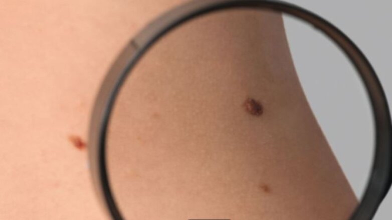 Εμβόλιο mRNA κατά του καρκίνου σε συνδυασμό με ανοσοθεραπεία μειώνει σημαντικά την υποτροπή του μελανώματος